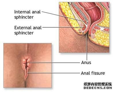 肛裂是什么引起的